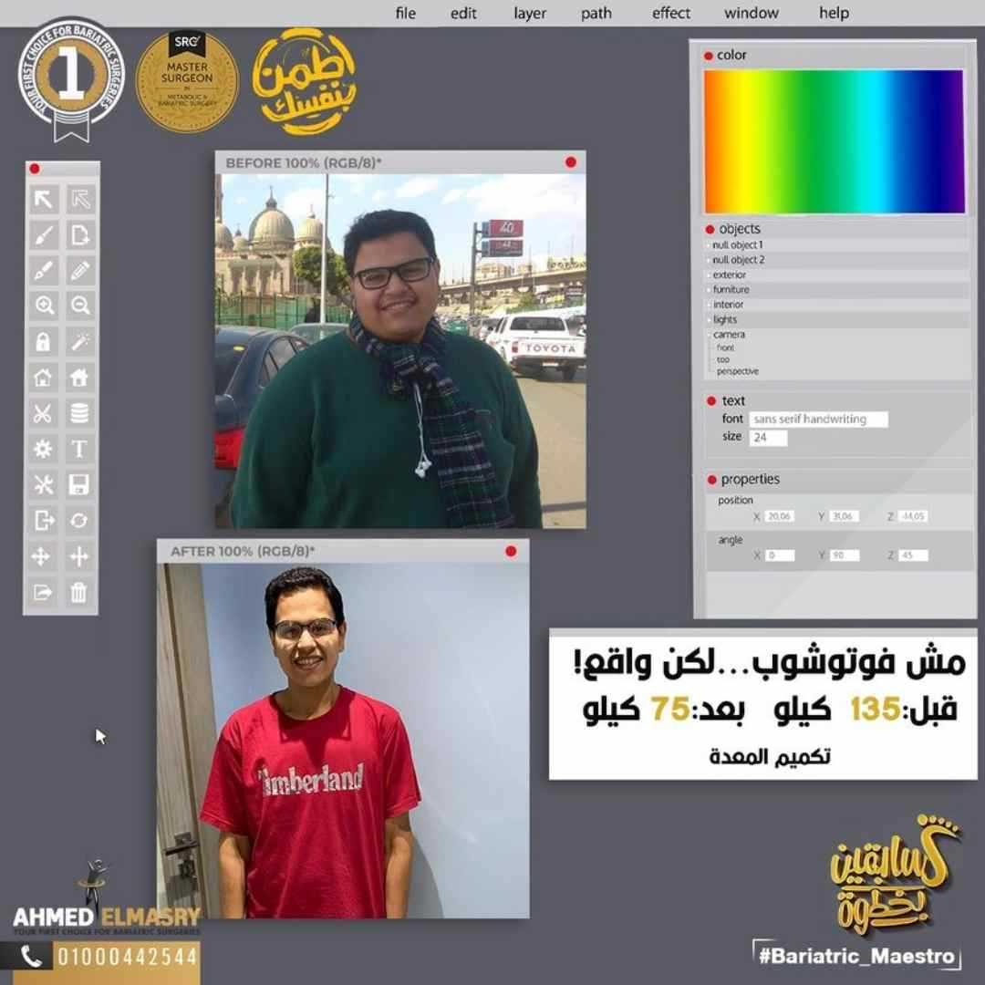 تكميم المعده قبل وبعد